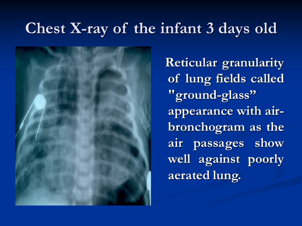 Chest X-ray of the infant 3 days old Reticular granularity of lung fields called